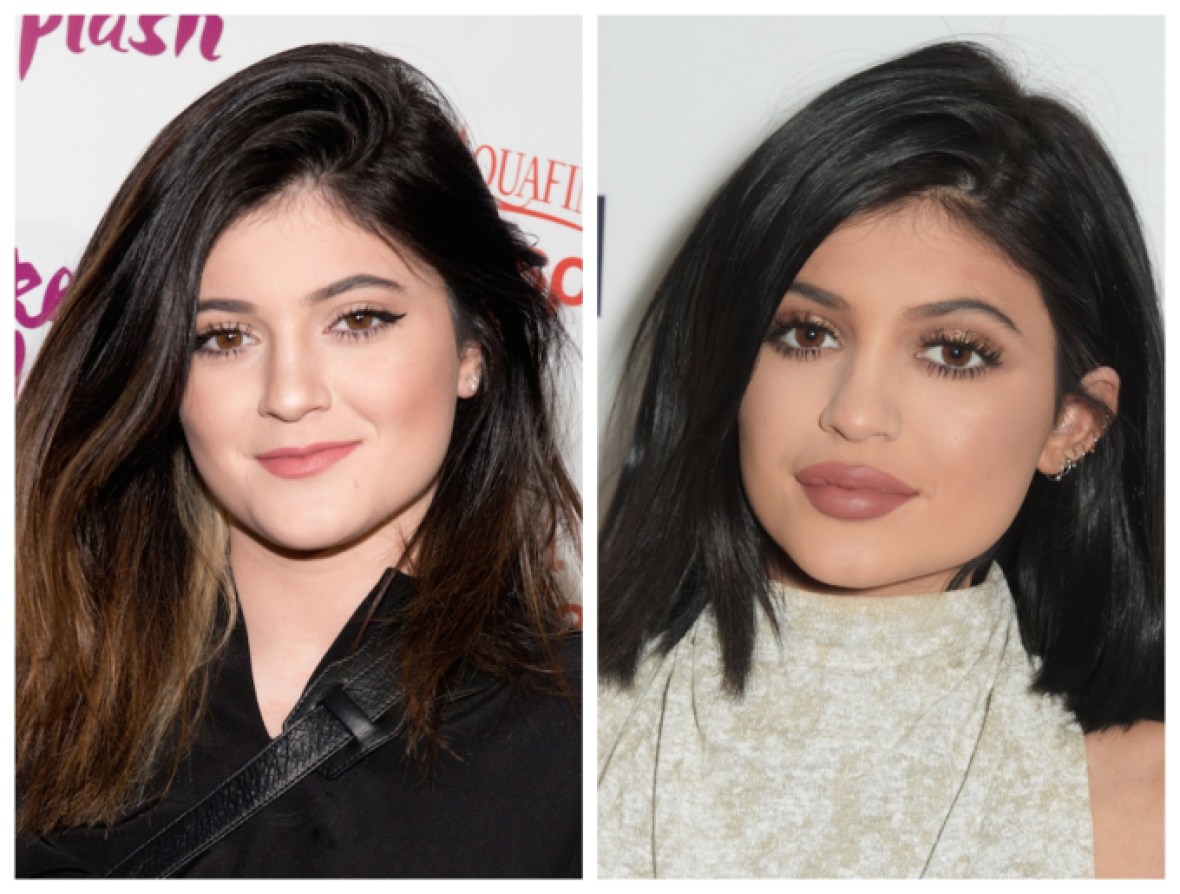 Kylie Jenner Finally Admits To Getting Lip Injections Life And Style 1007