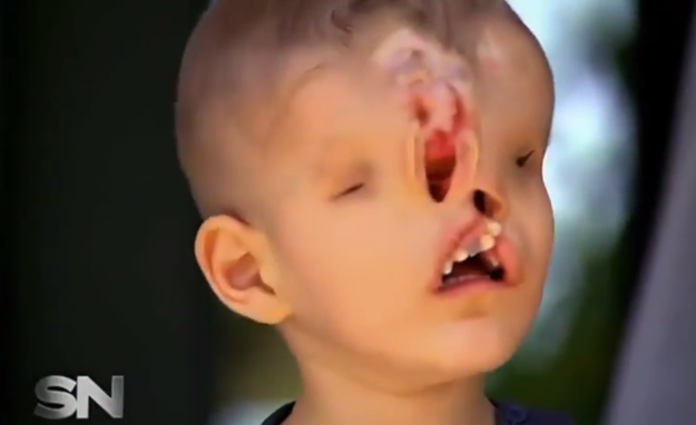baby born without eyes