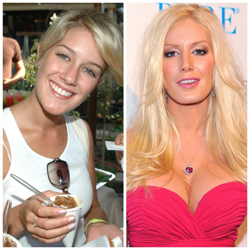 plastic surgery disasters before and after