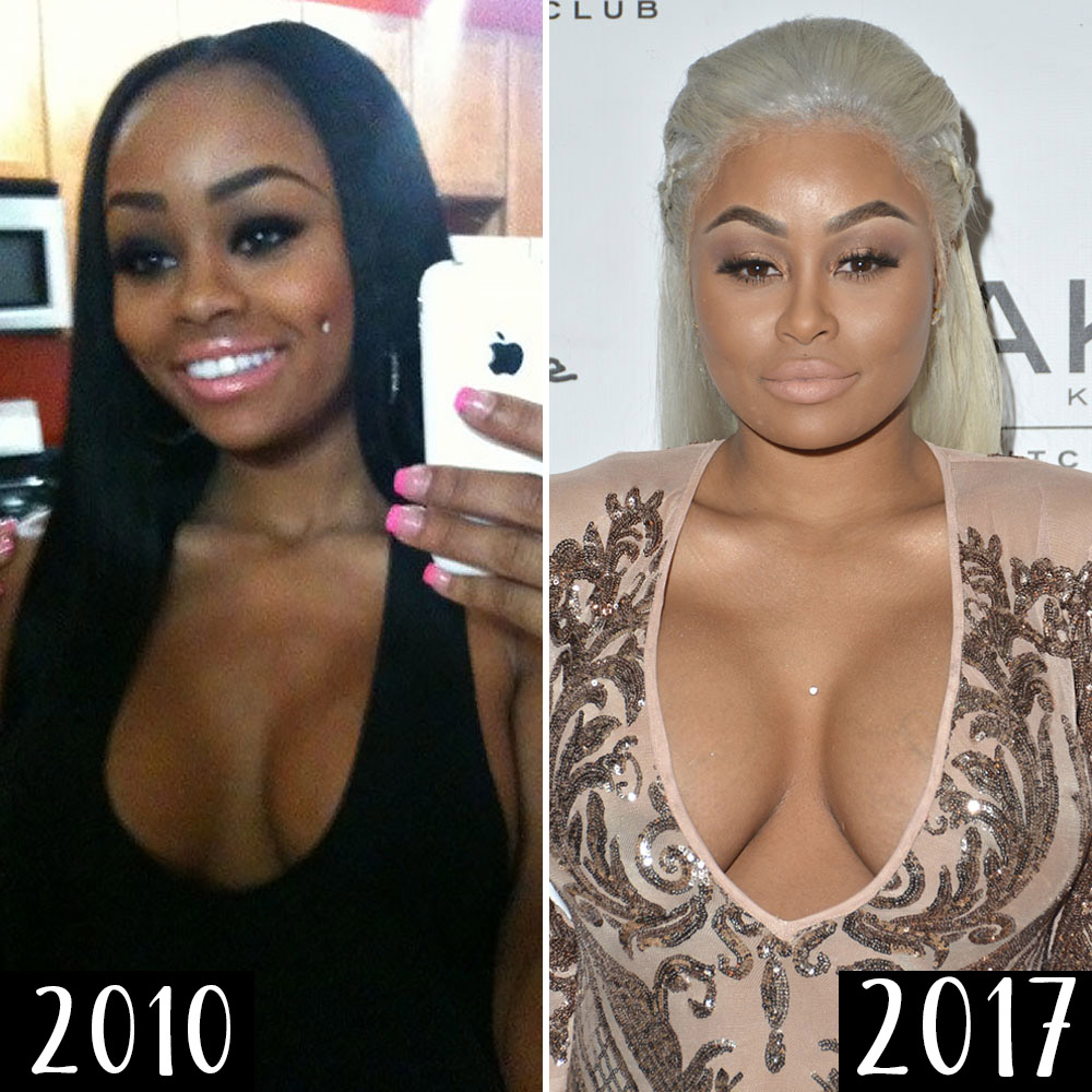 Blac Chyna Tits - Did Blac Chyna Get Plastic Surgery? See What the Experts Say