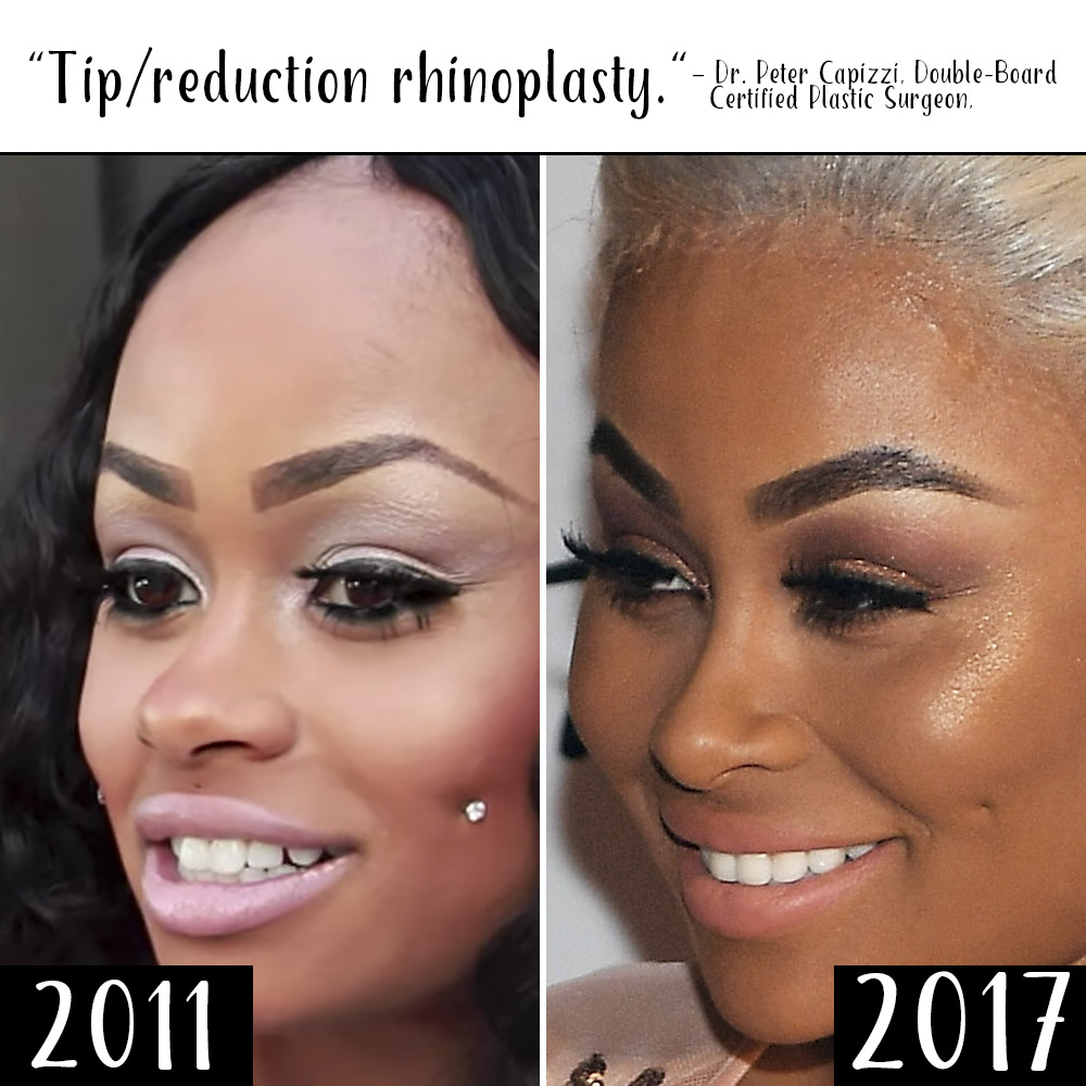 Did Blac Chyna Get Plastic Surgery See What The Experts Say