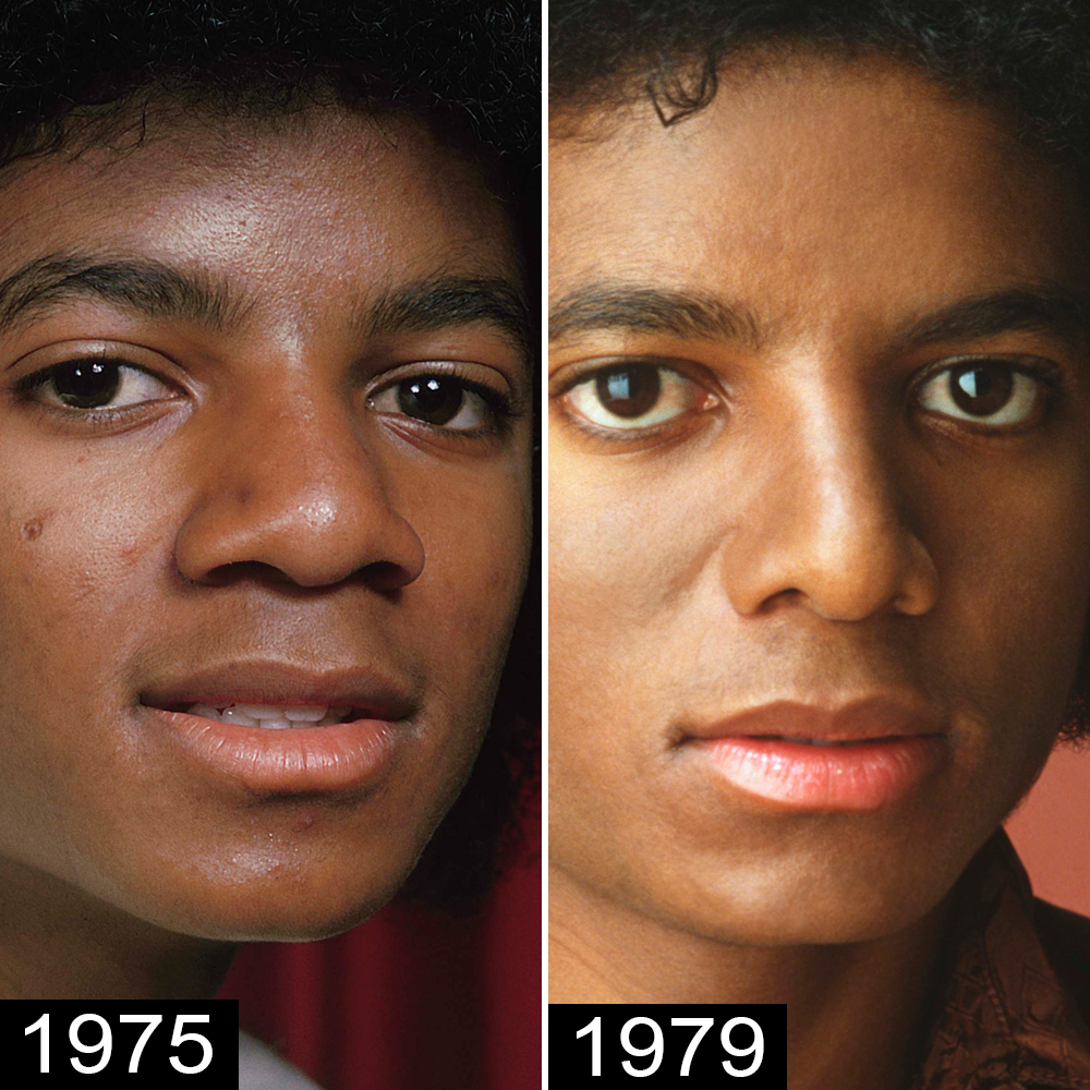 Michael Jackson explained his skin disorder after claims he was bleaching  it to become white