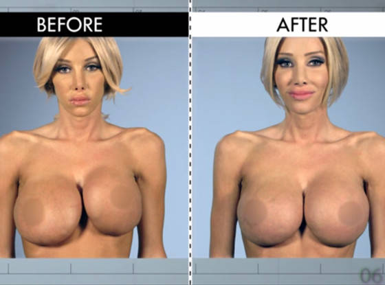 See The Most Extreme Plastic Surgery Transformations On Botch