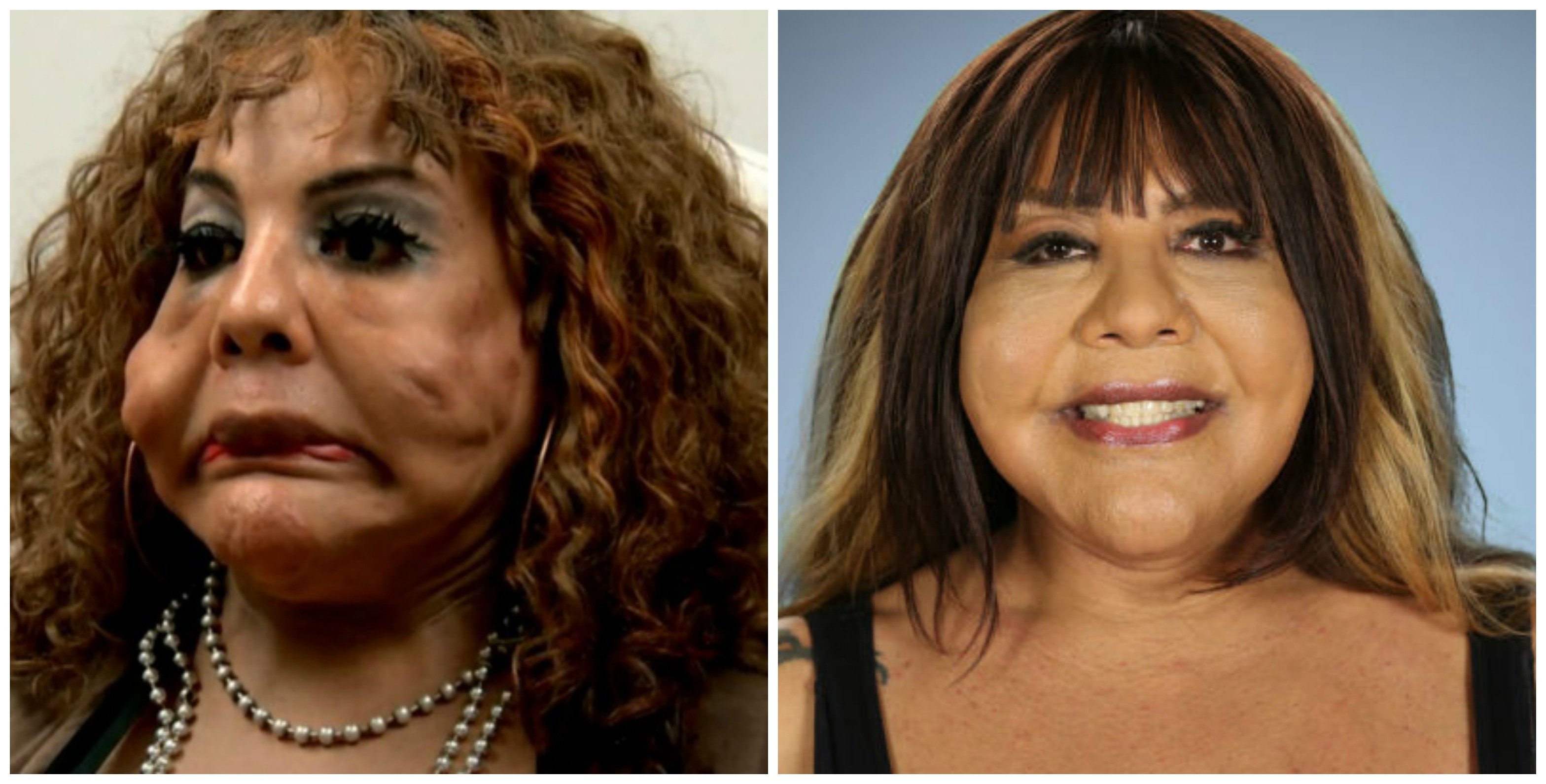 See The Most Extreme Plastic Surgery Transformations On Botched Life And Style 3689