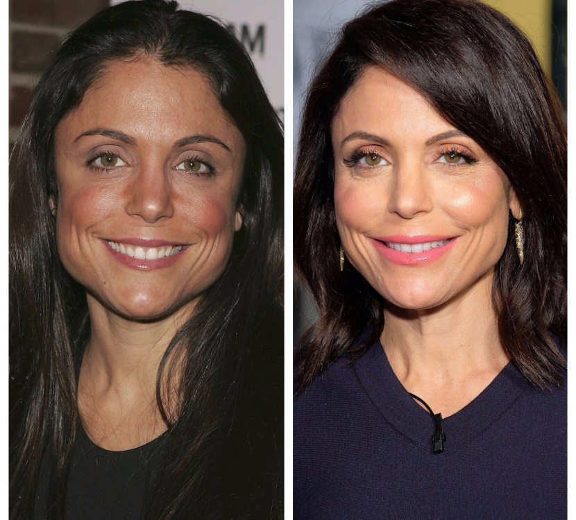 Bethenny Frankel Plastic Surgery The RHONY Star Has Admitted to Botox