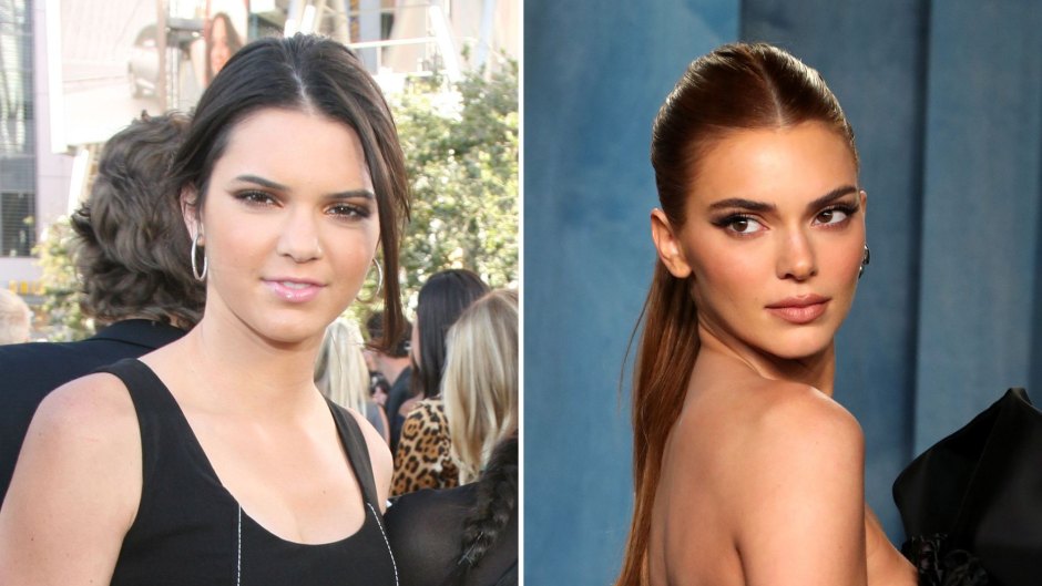 Kendall Jenner Plastic Surgery Revealing The Truth Behind Her Transformation